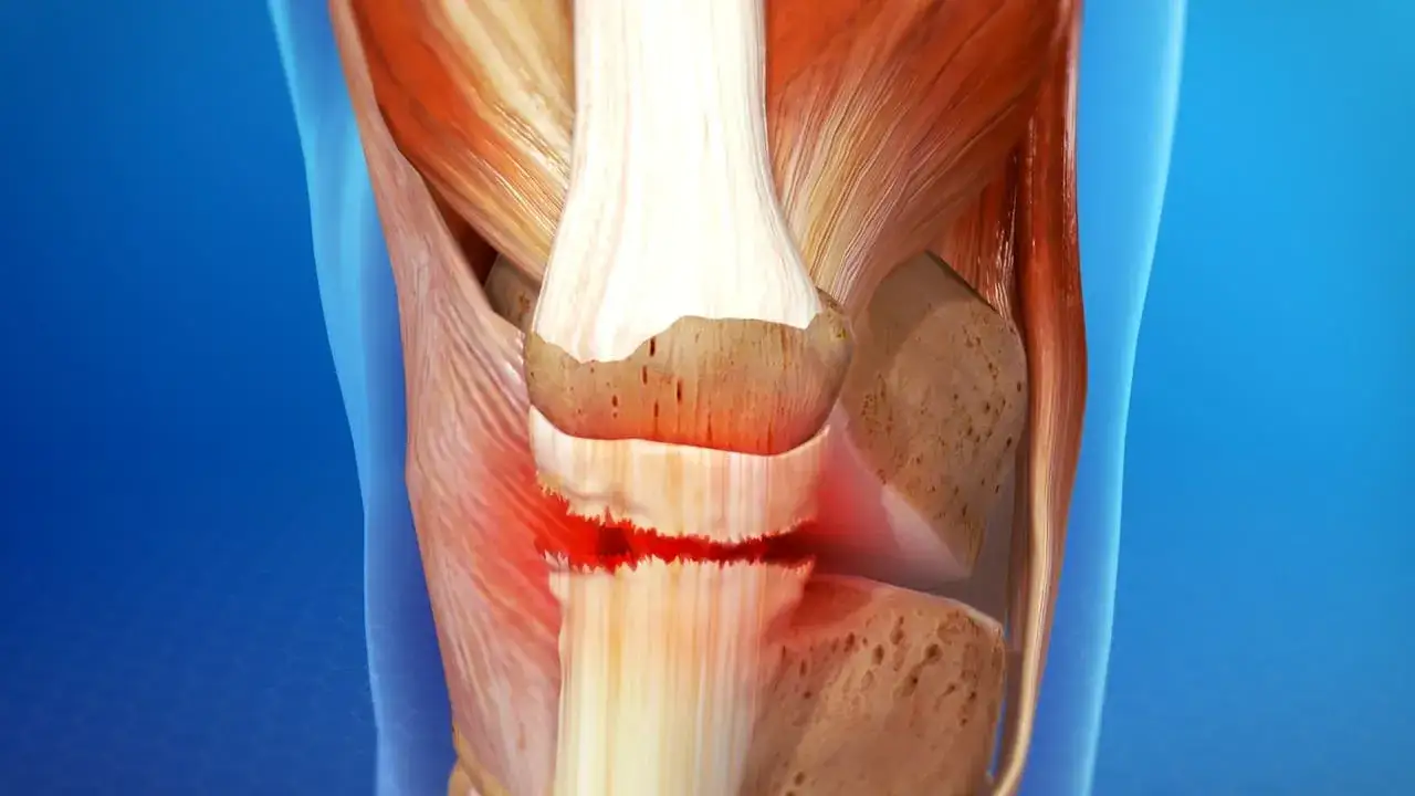 Zdjęcie Recto anterior: Guía completa para evitar y curar su lesión