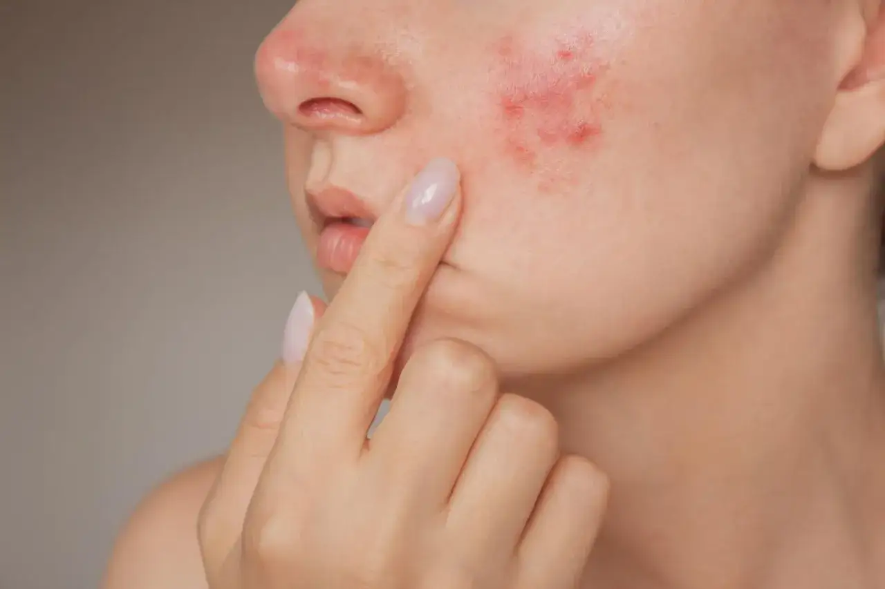 olejek z drzewa herbacianego na pryszcze, domowe sposoby