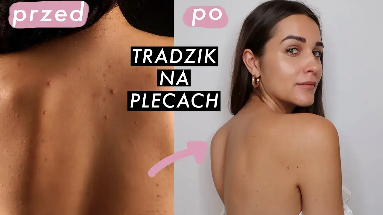 kosmetyki na trądzik na plecach