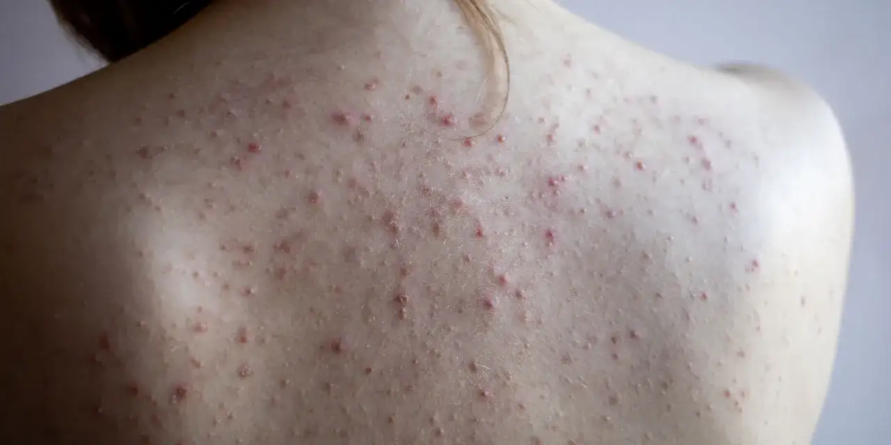 Przyczyny trądziku na plecach infografika