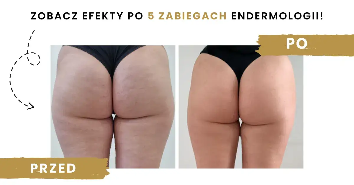 Przeciwwskazania do endermologii infografika