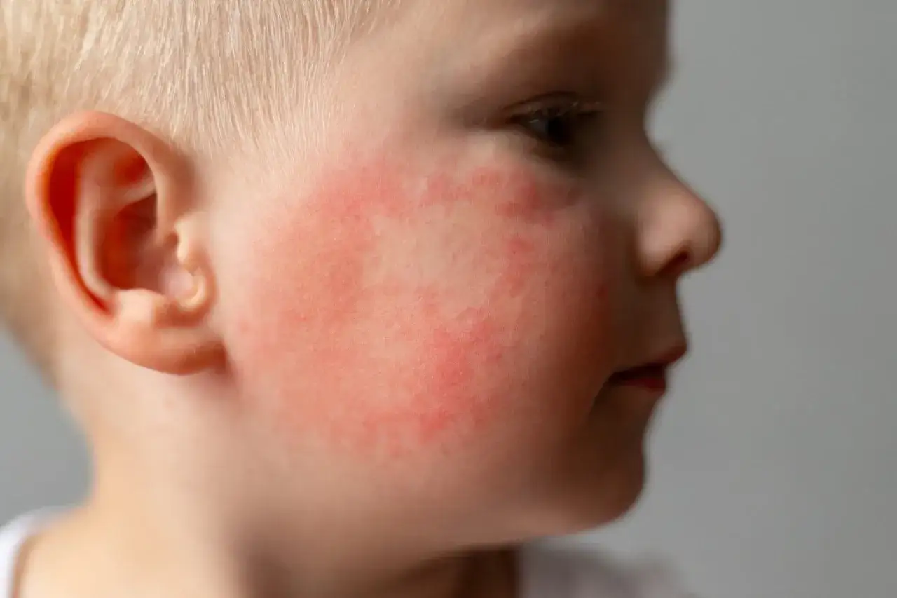 Rumień zakaźny u dzieci objawy: czerwone policzki, jakby dziecko dostało 