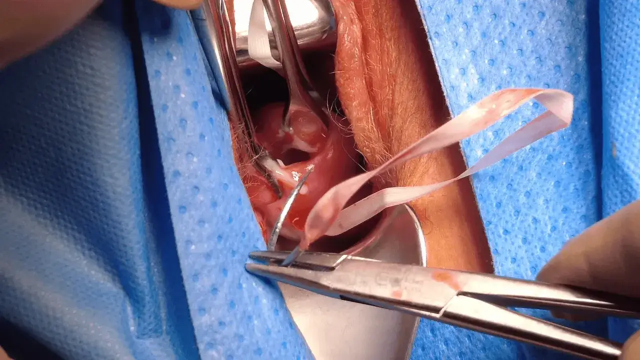 Szew okrężny szyjki macicy pessar szyjkowy