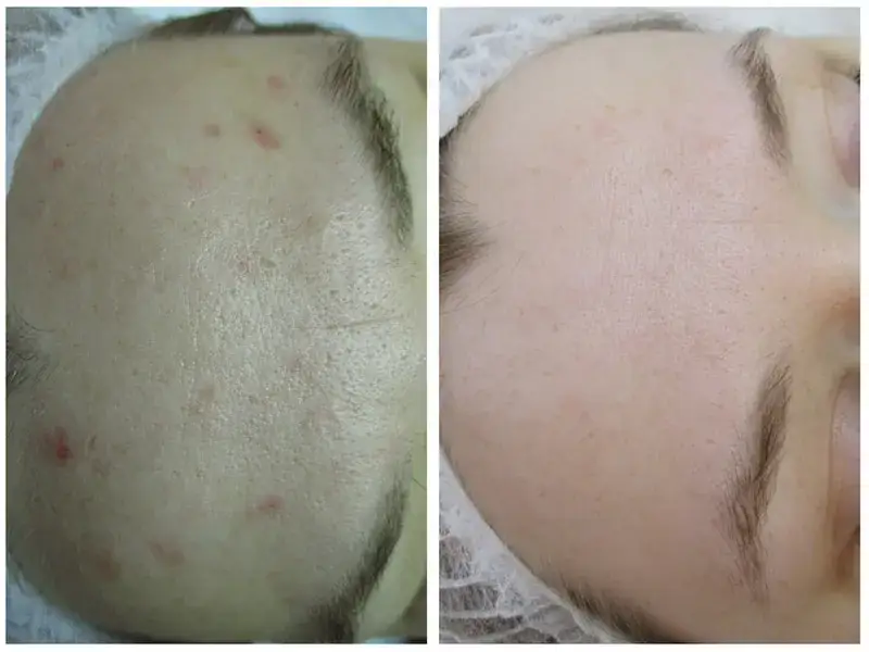 Laseroterapia na czerwone ślady po trądziku przed i po