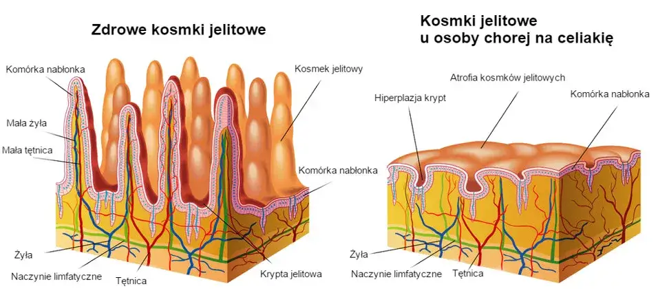 por&oacute;wnanie jelita zdrowego i jelita z celiakią