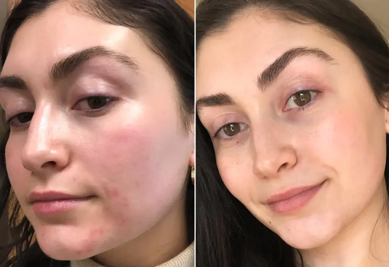 laser treatment for post acne red marks