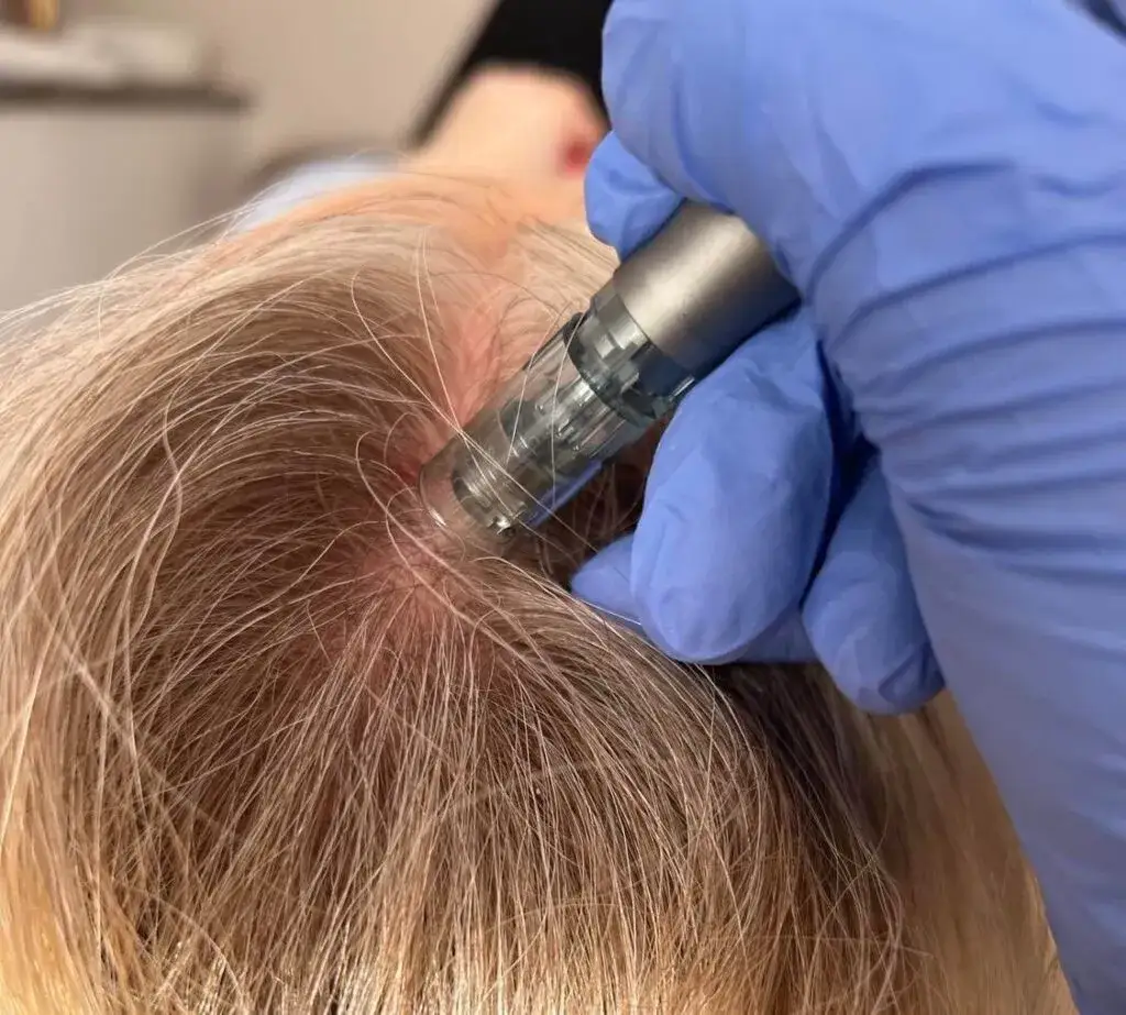 mezoterapia igłowa sk&oacute;ry głowy