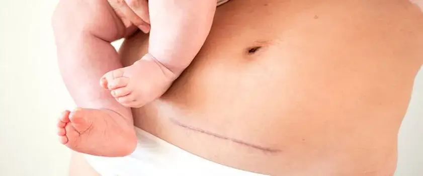 Zdjęcie Jak wygląda blizna po cesarce? Co warto wiedzieć o jej wyglądzie