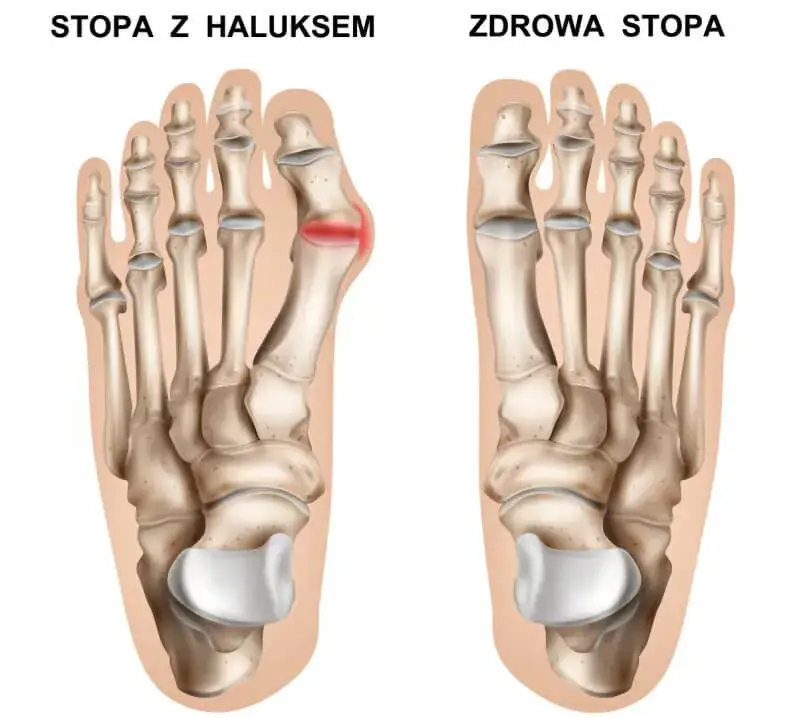 stopa z haluksem, anatomia haluksa
