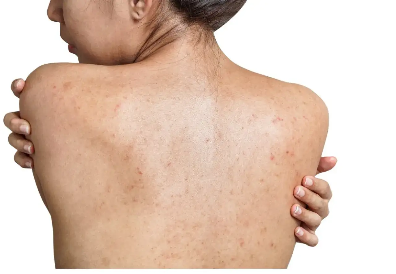 Pryszcze na plecach przyczyny
