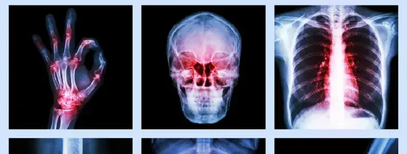 objawy niedoboru witaminy K2 kości serce