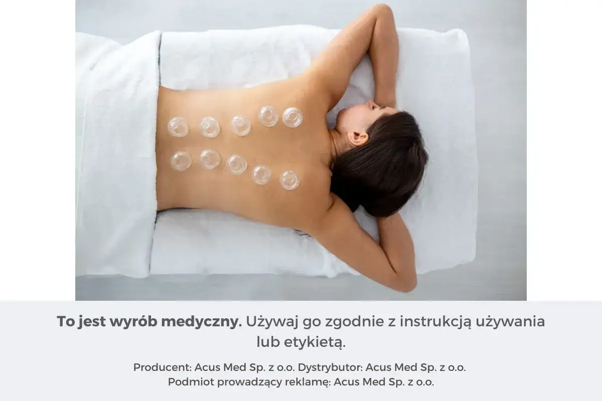 Kobieta leży na plecach z bańkami na zatoki umieszczonymi na plecach.