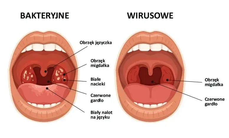 r&oacute;żnica wirusowe bakteryjne zapalenie gardła