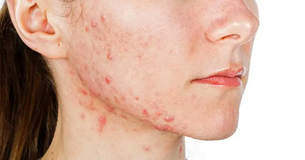 Zdjęcie Co jest dobre na pryszcze? Skuteczne metody na walkę z trądzikiem