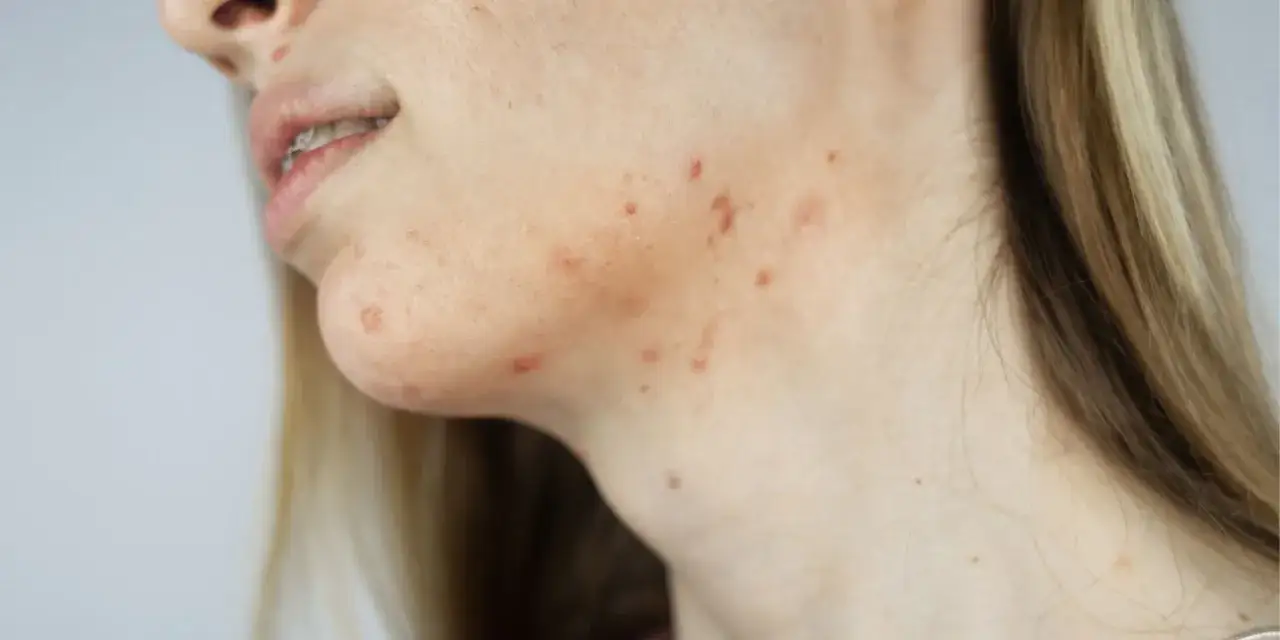 Kobieta z trądzikiem hormonalnym na brodzie