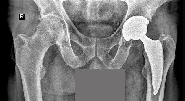 Zdjęcie Endoproteza stawu biodrowego nfz gdzie najlepiej – wybierz mądrze