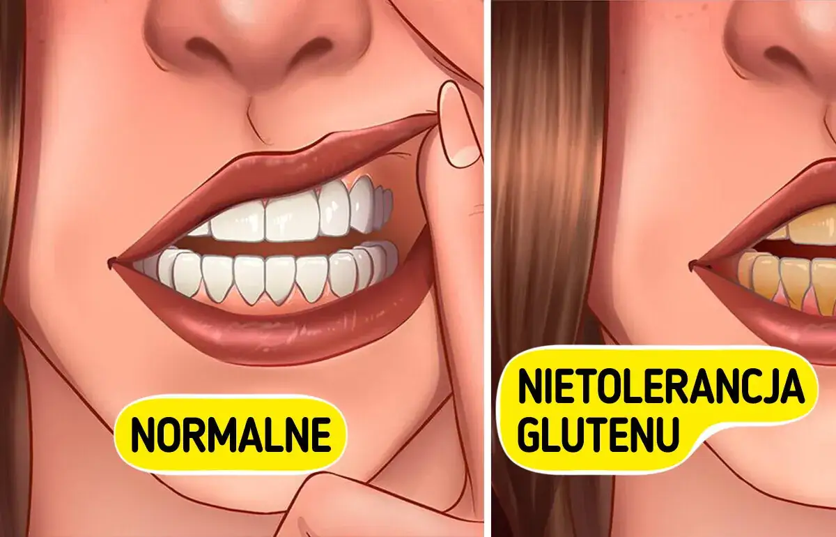 objawy sk&oacute;rne nietolerancji glutenu, zmęczenie mgła m&oacute;zgowa