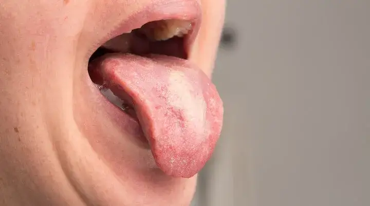 Zapalenie języka glossitis niedobory witamin