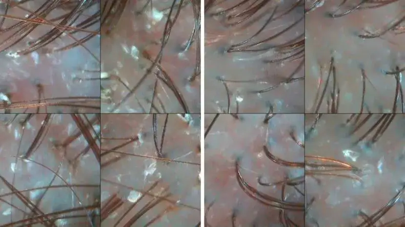 sk&oacute;ra przed i po delikatnym peelingu enzymatycznym