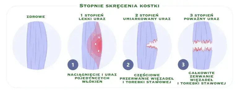Rodzaje skręcenia kostki stopnie urazu