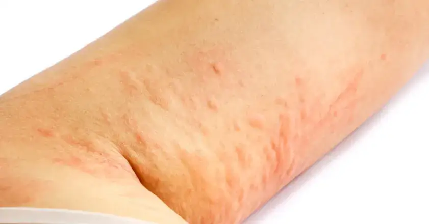 Wyprysk kontaktowy zdjęcia reakcji na metale kosmetyki detergenty