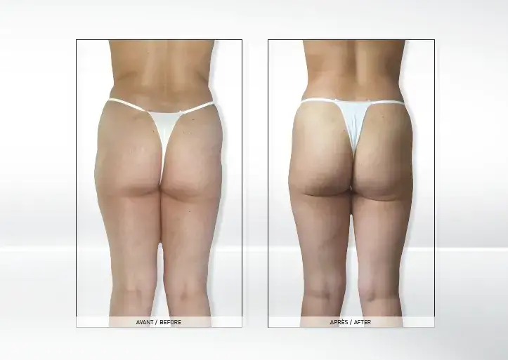 kriolipoliza endermologia por&oacute;wnanie zabieg&oacute;w