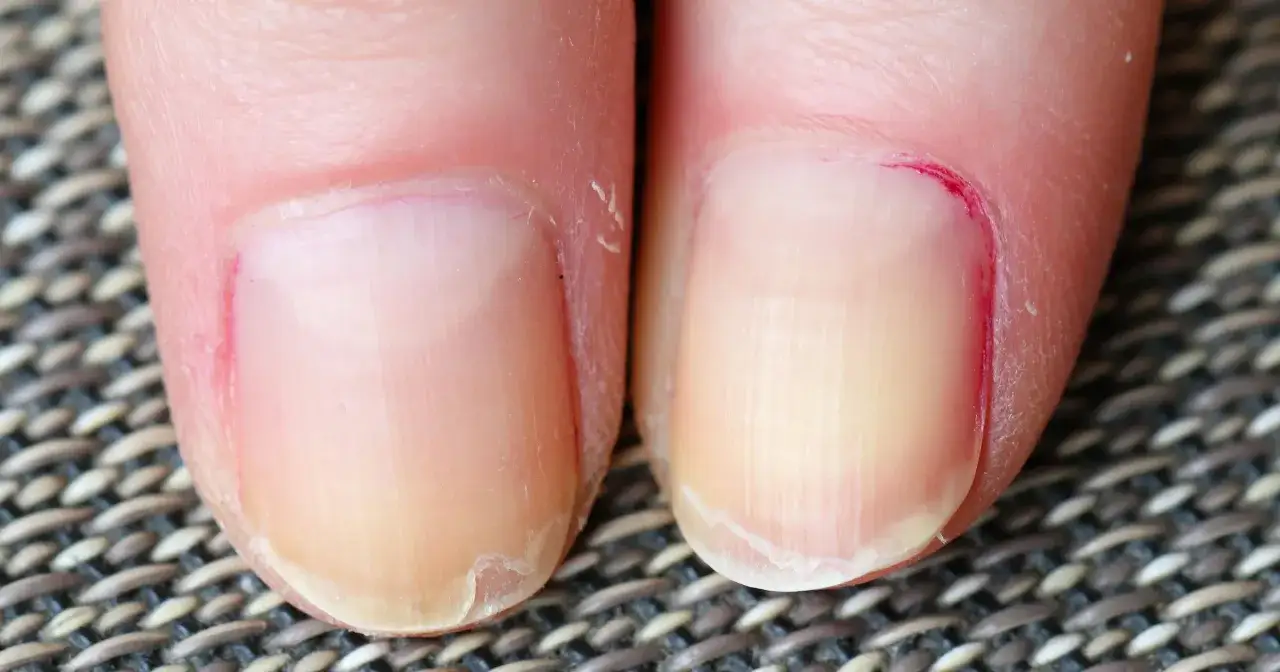 Objawy niedoboru białka w organizmie