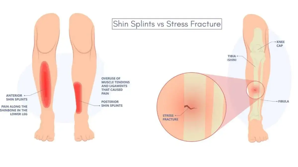 r&oacute;żnica shin splints złamanie zmęczeniowe