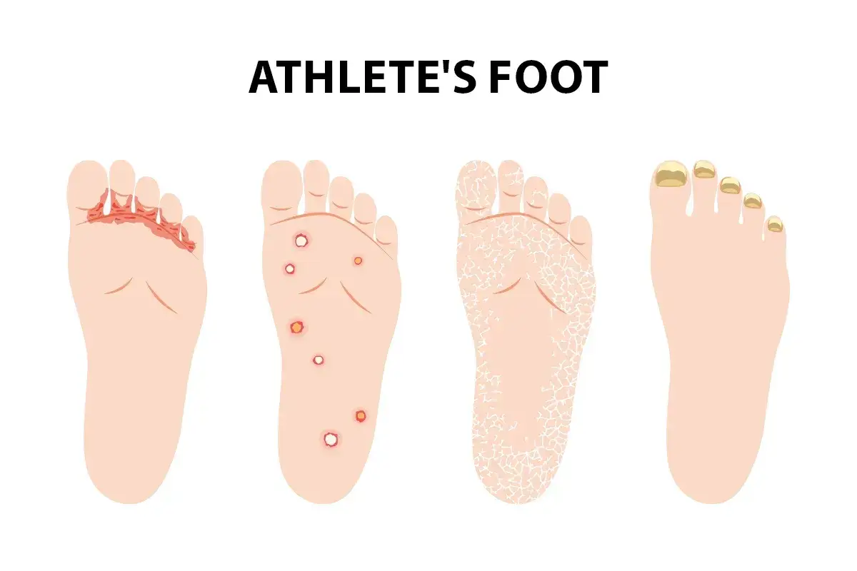 Ilustracja przedstawia różne stadia grzybicy stóp: zaczerwienienie między palcami, pęcherze, łuszczenie się skóry i żółte paznokcie.