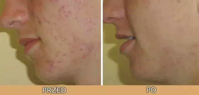 kwas salicylowy i hialuronowy razem efekty