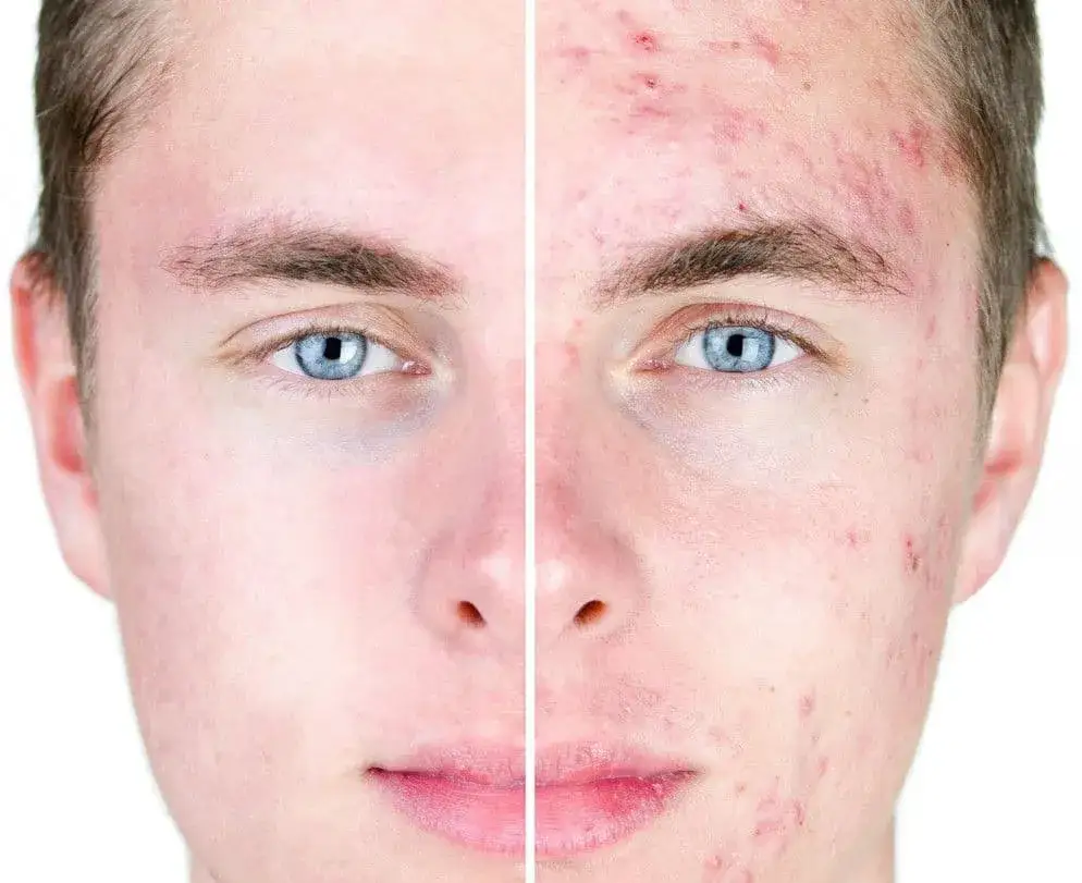 Kiedy iść do dermatologa z trądzikiem