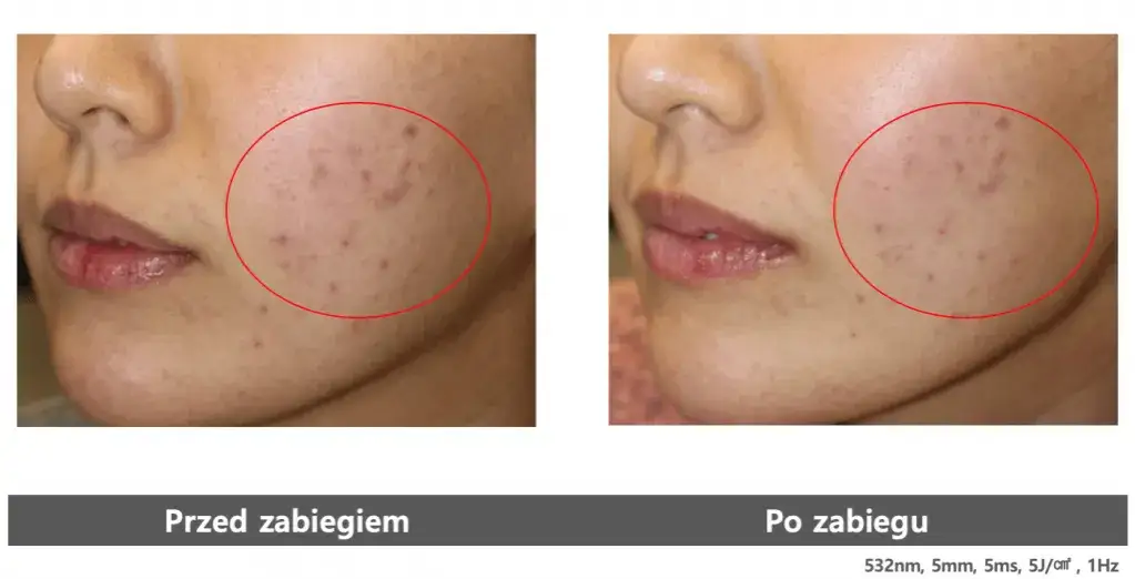 Laseroterapia naczyniowa przed i po