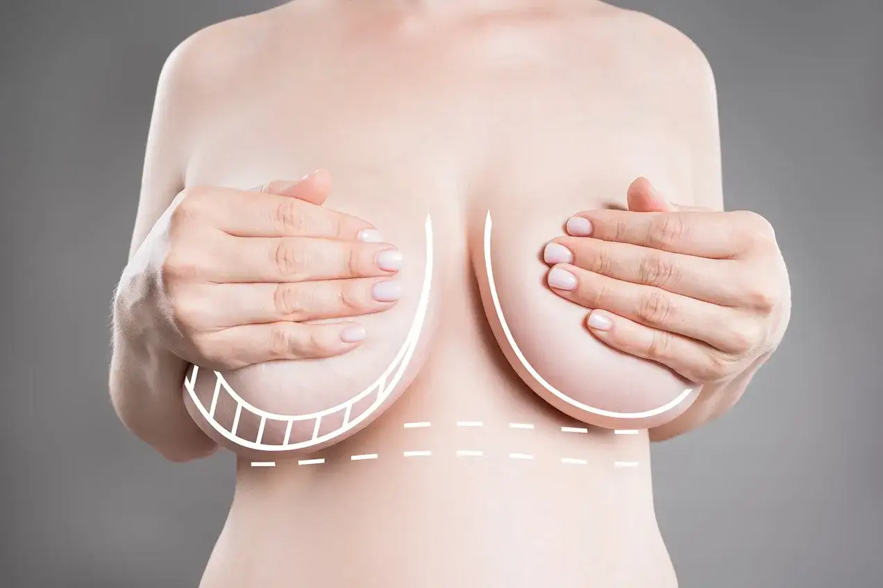 Kobieta prezentuje swoje piersi po porodzie, z zaznaczonymi liniami sugerującymi zabieg chirurgiczny.