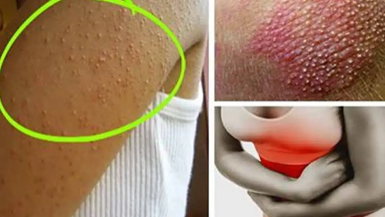 objawy nietolerancji glutenu zmęczenie b&oacute;l brzucha wysypka