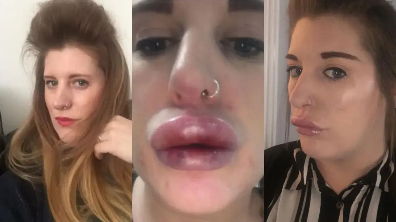 kobieta z zimnym okładem na ustach po powiększaniu