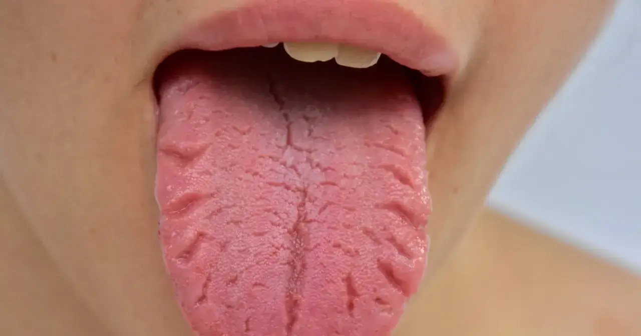 Popękany język może być problemem. Dowiedz się, jak wyleczyć popękany język i przywrócić mu zdrowy wygląd.