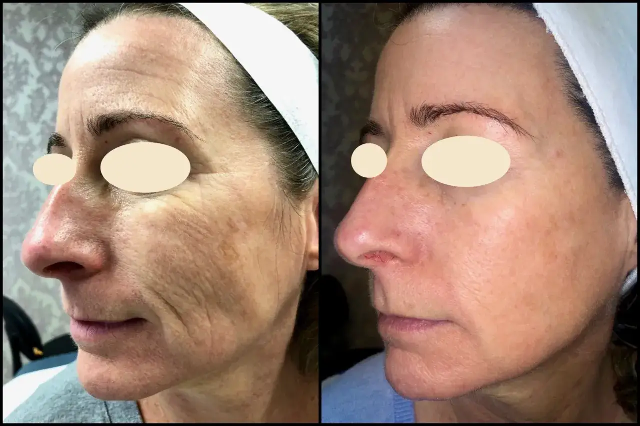 Przed i po laserowym odmładzaniu twarzy: widoczna redukcja zmarszczek i przebarwień, sk&oacute;ra gładsza i jaśniejsza.