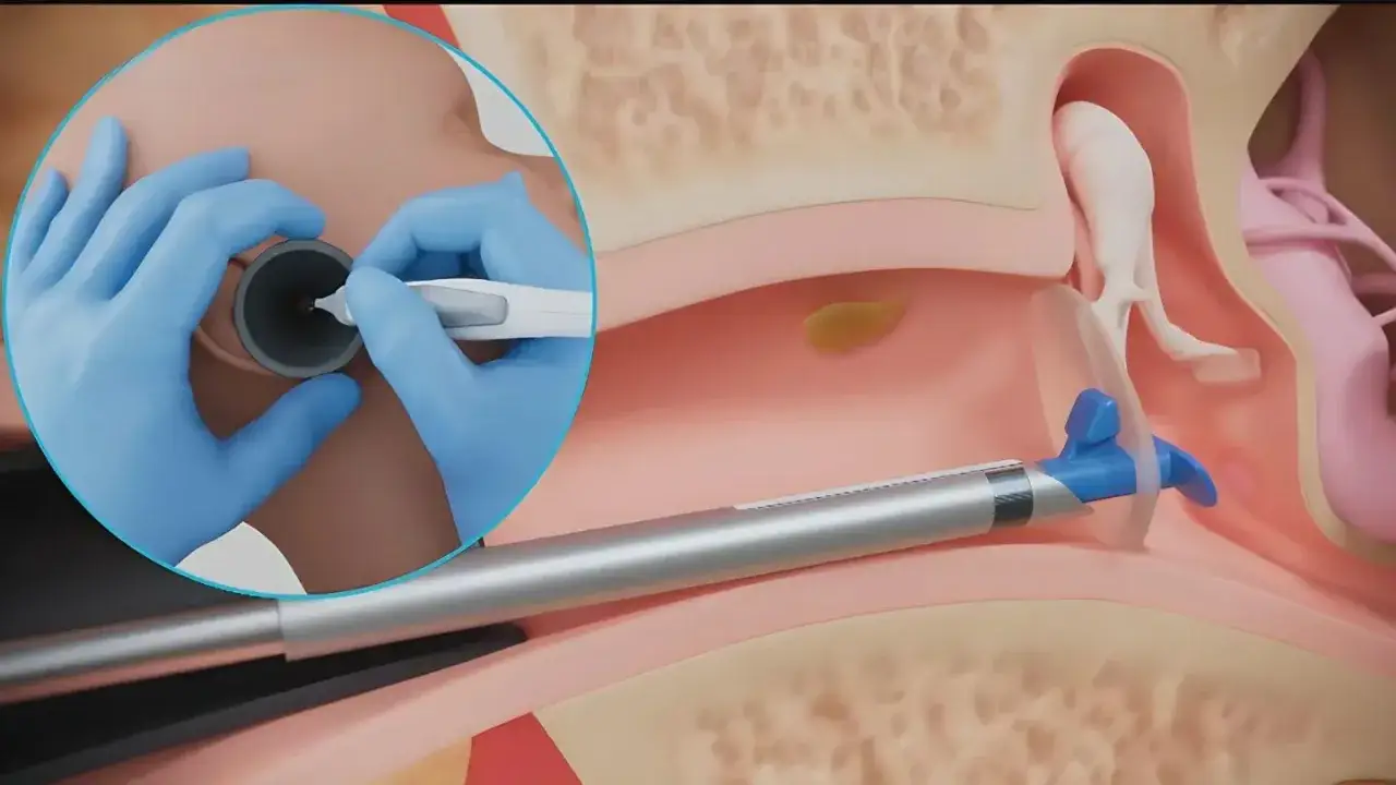 Ilustracja medyczna przedstawiająca drenaż uszu. W uchu umieszczany jest dren, by zapewnić odpływ płynu.