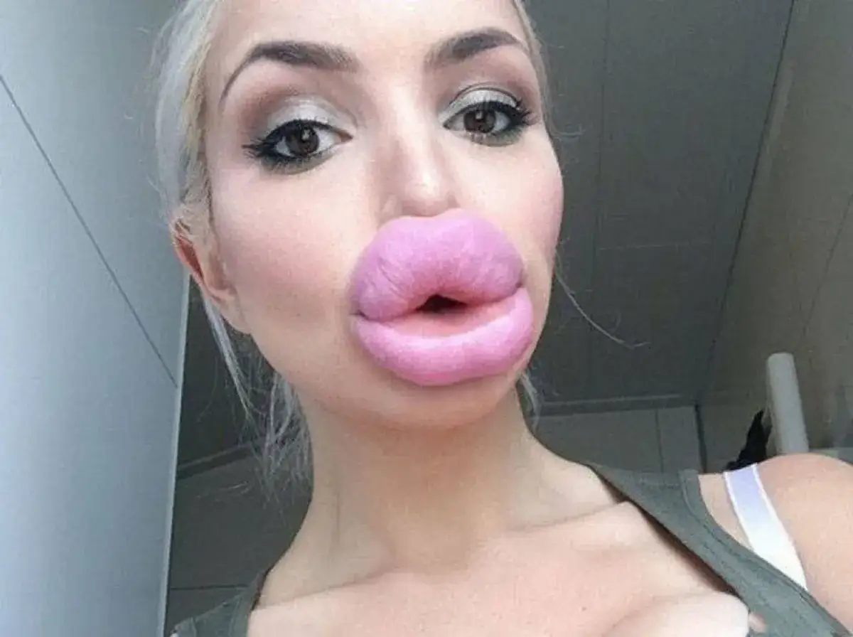Kobieta z powiększonymi ustami, delikatnie dotykająca ust, zaniepokojona