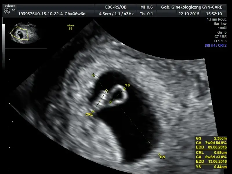 USG ciąży wczesnej