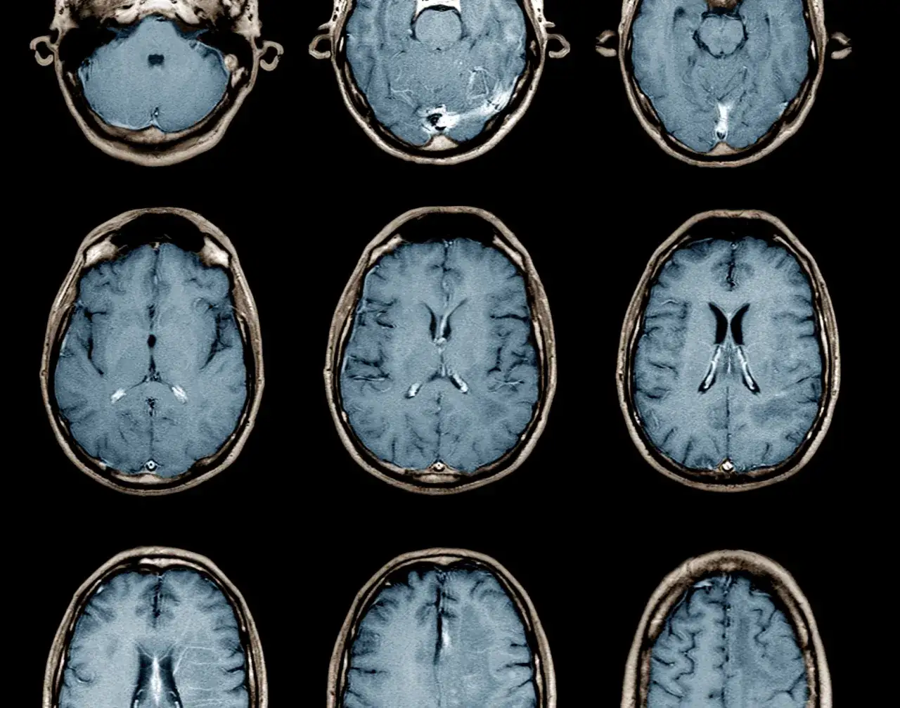 EEG czepki implanty mózgowe porównanie