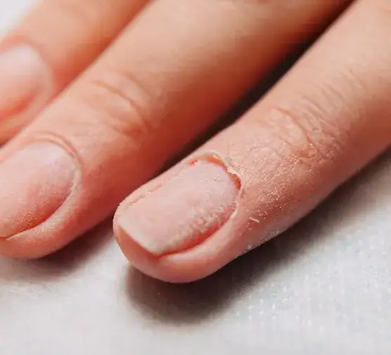 Zdrowe i zniszczone paznokcie po hybrydzie, uszkodzenia paznokci od hybrydy