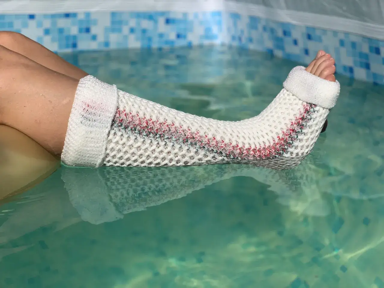 gips na stopie vs orteza stawu skokowego