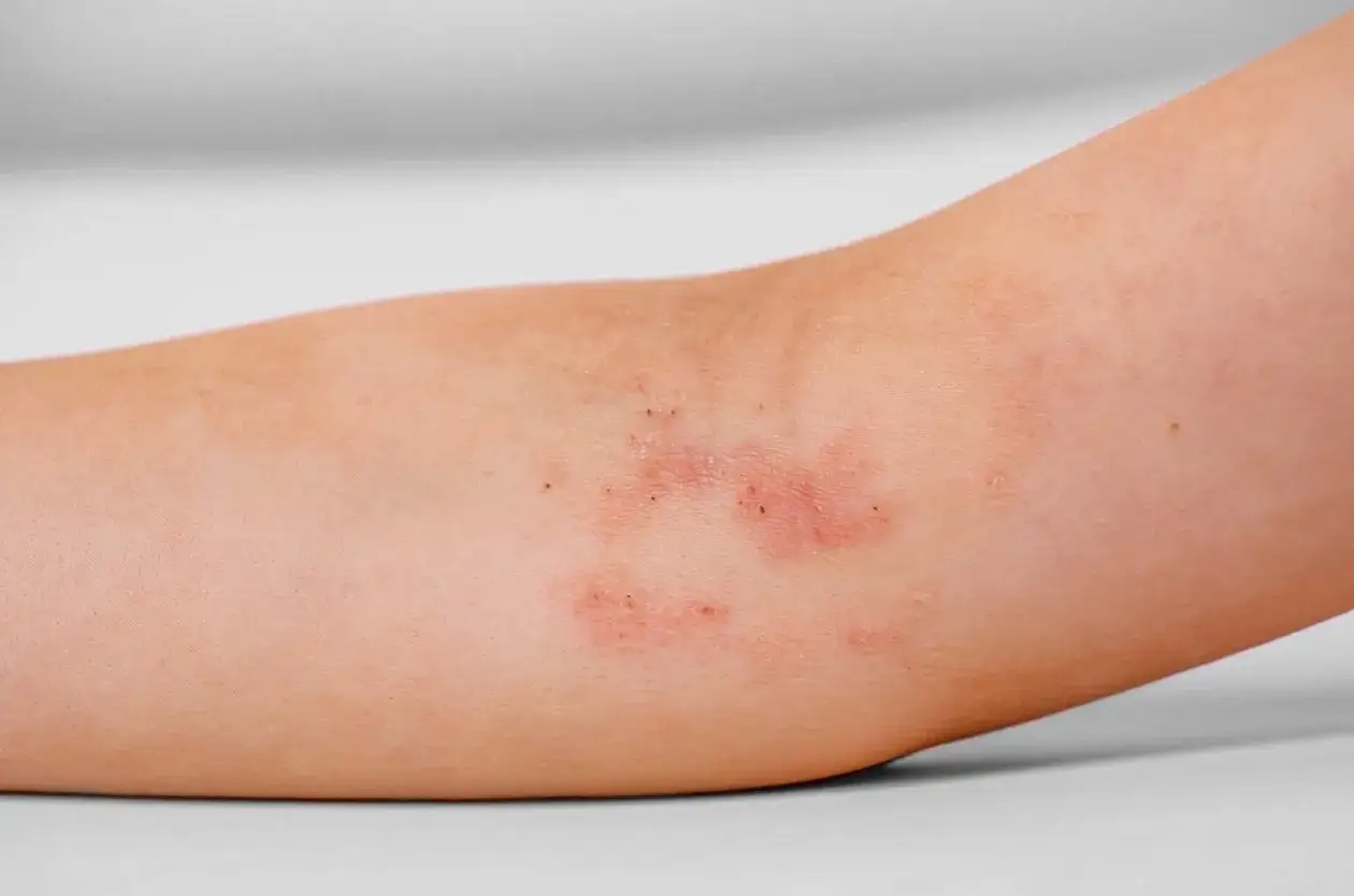 Skóra z zaczerwienionymi, swędzącymi zmianami, które mogą być objawem alergii lub podrażnienia. Widoczne są drobne przeczosy na skórze.