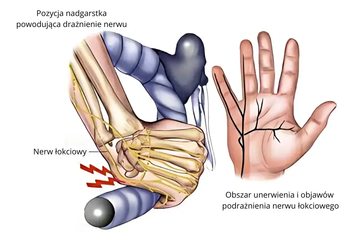 Anatomia nerwu łokciowego w okolicy łokcia