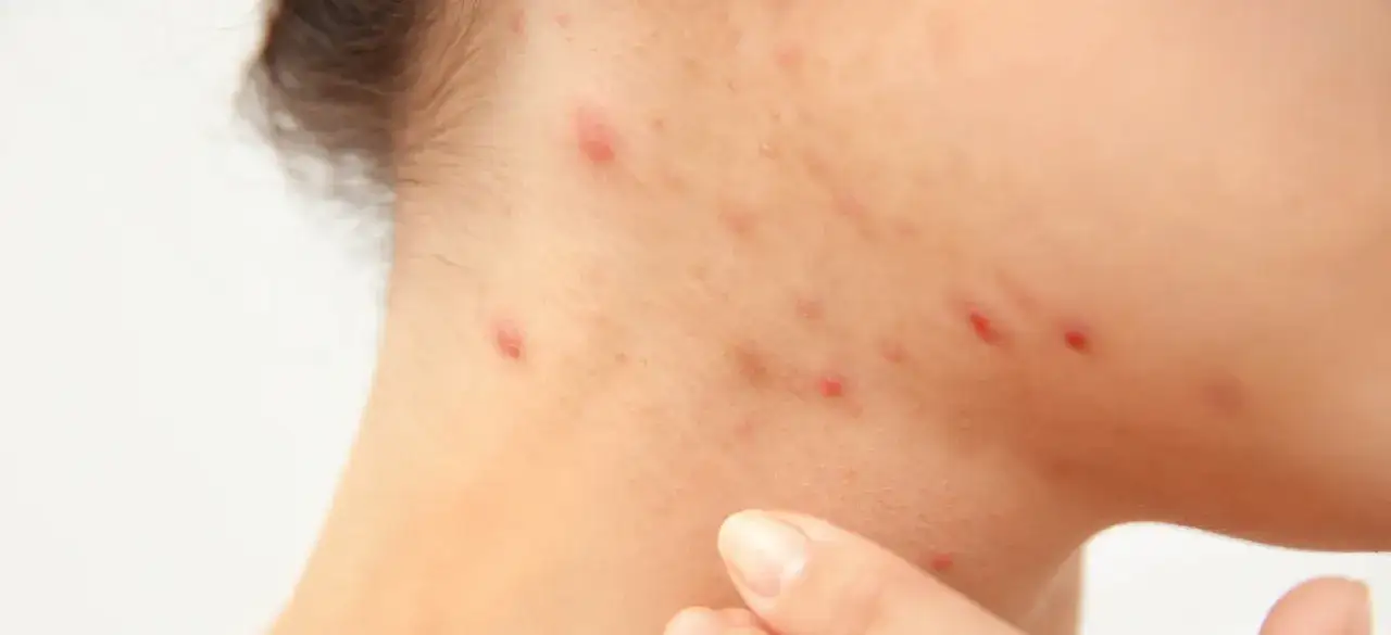 Widoczne liczne czerwone znamię na skórze, w tym wypryski i zaczerwienienia na policzku i szyi.