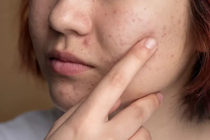 Kiedy iść do dermatologa z trądzikiem