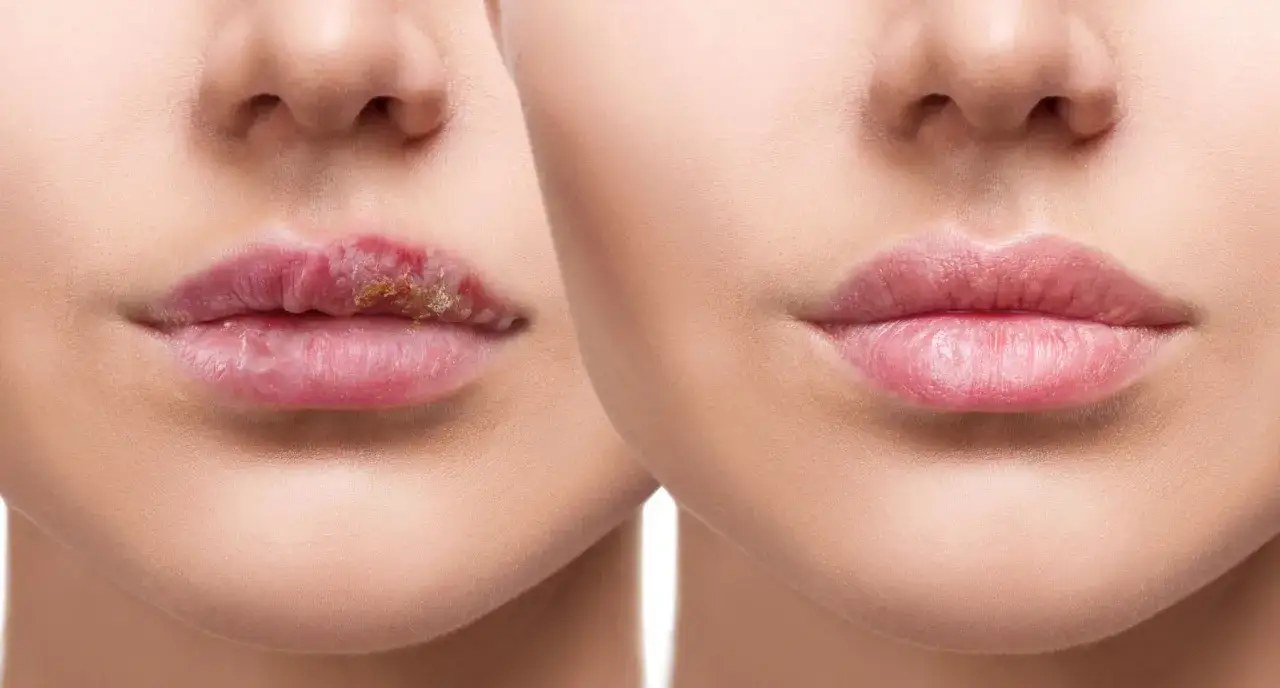 Zdjęcie Opryszczka na ustach po makijażu permanentnym - skuteczne sposoby leczenia