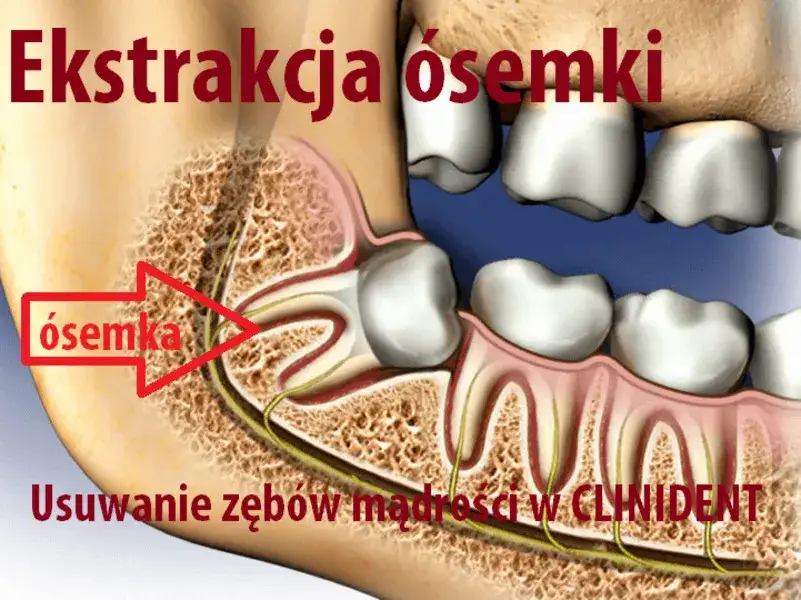 porównanie prostej ekstrakcji zęba a chirurgicznego usuwania ósemki