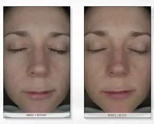 endermologia twarzy przed i po